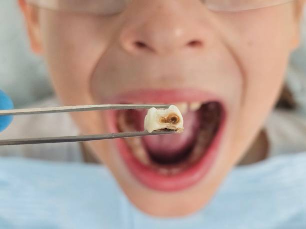 Best Emergency Dental Extractions in Ridge Wood Heights, FL